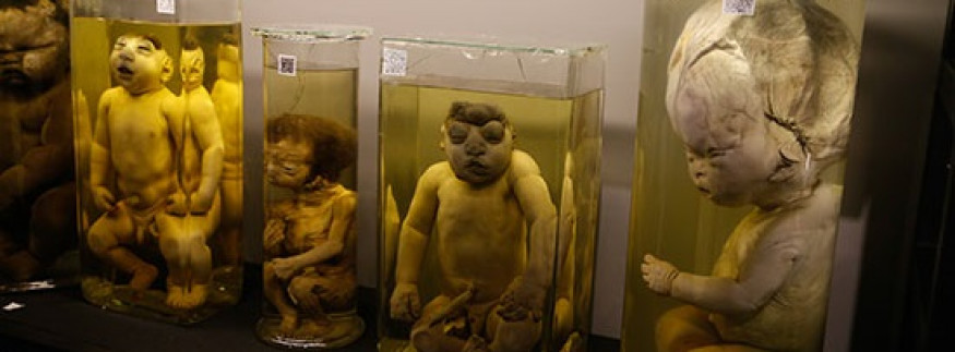 Rare Specimens of Unborn Children on Display at the Obstetrics & Gynaecology Museum